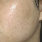 水光针治痘痘有用吗