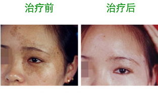 激光祛斑后可以化妆吗