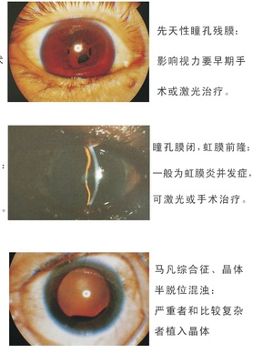 新生儿瞳孔残膜