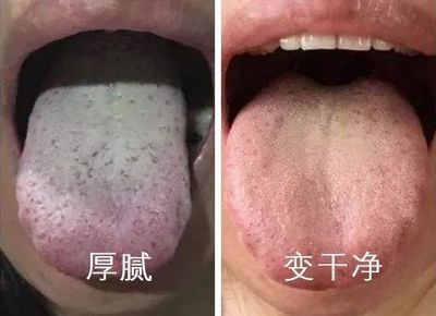 舌苔没了是怎么回事