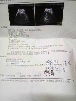 胎儿sd值偏高怎么回事
