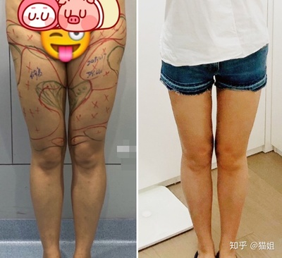 抽脂后疼痛感多久恢复