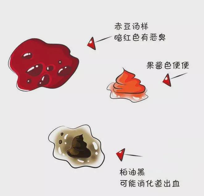 新生儿大便出血