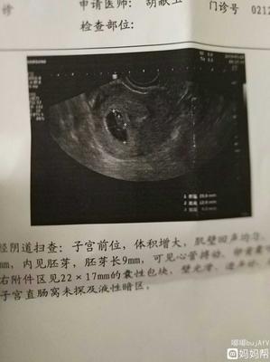 怀孕35天能看到孕囊吗