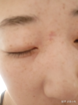 祛痣后的红印怎样消除