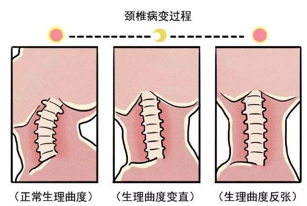 颈椎反张怎么治疗