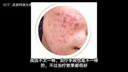 玫瑰痤疮怎么治疗最快