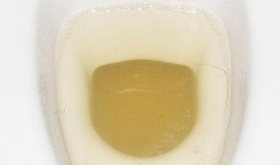 小便混沌是怎么回事