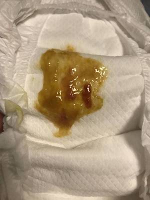 大便带脓是怎么回事