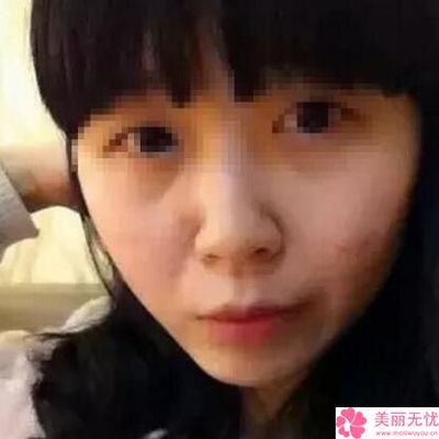 南京激光祛痘痘该去哪里