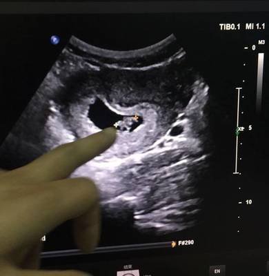 怀孕能吃腰果仁吗