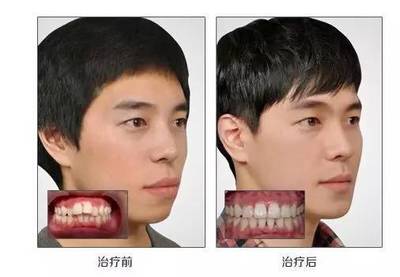 牙齿矫正时间要多久