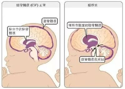 脑子有积液是怎么回事