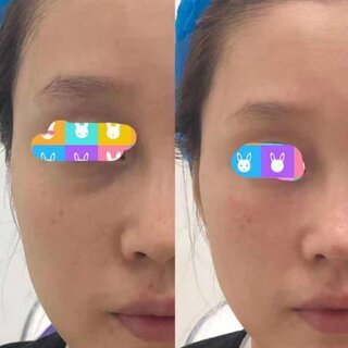 玻尿酸打泪沟几天消肿