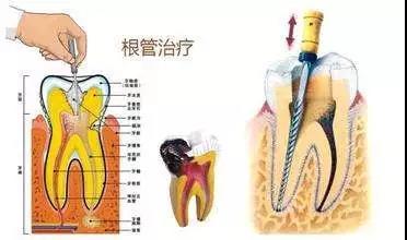 残髓炎怎么治疗