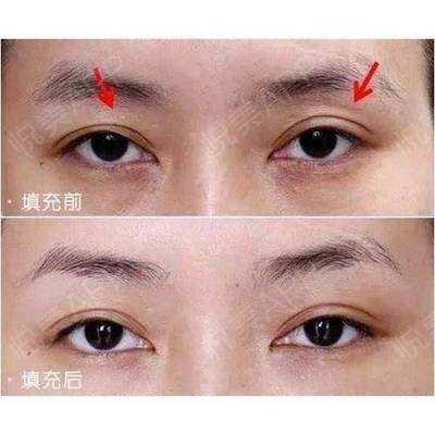 眼窝凹陷玻尿酸填充