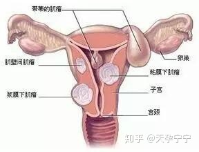 怀孕后盆腔炎发作怎么办