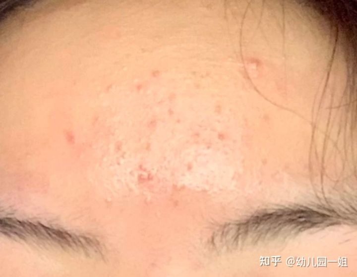 额头长闭口痘痘是什么原因