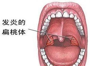 喉咙感觉有臭味是怎么回事