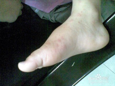 臭虫咬了怎么治疗