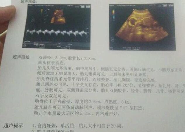 胎儿几个月有胎动正常