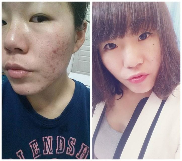 祛痘去痘印的方法