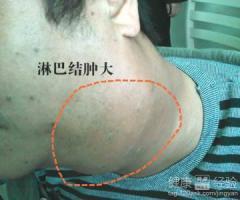淋巴发炎是怎么回事