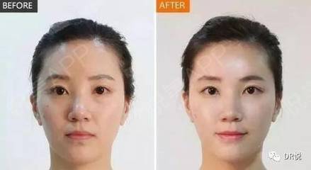 童颜针和水光针的区别