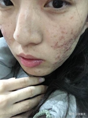 脸上长痘痘 偏方