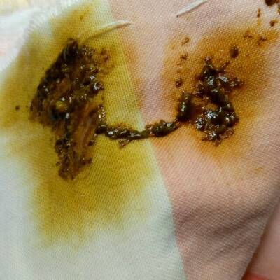 刚出生宝宝一天拉几次大便为正常