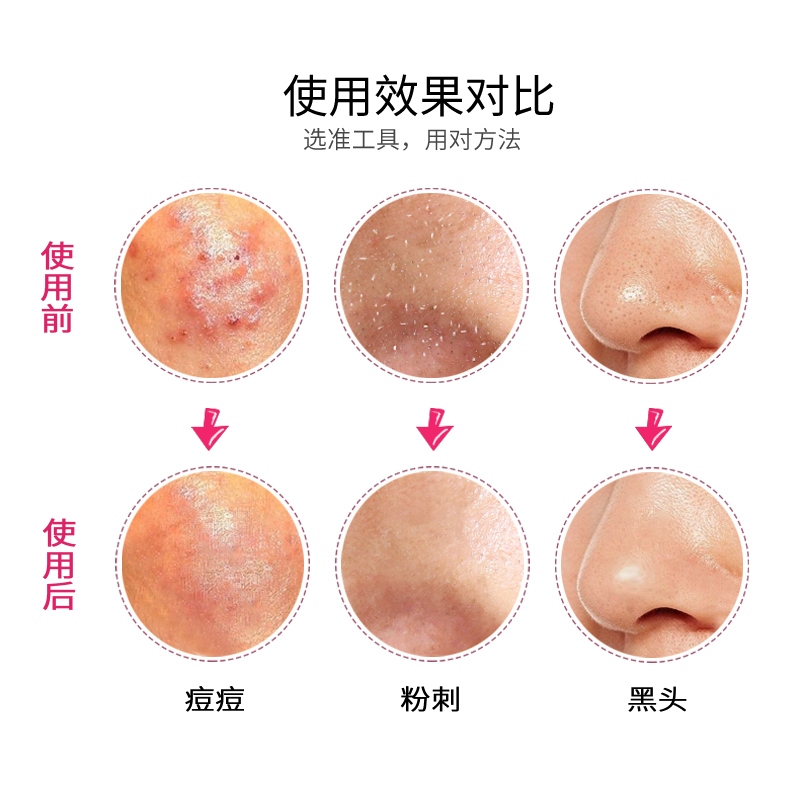 痘痘和粉刺啥区别