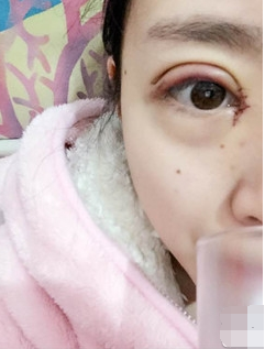 割完双眼皮肉条没知觉