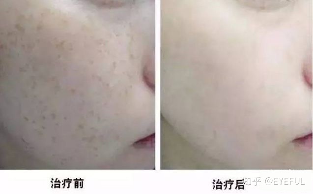 皮秒祛斑多久做一次