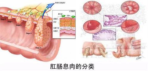 结肠息肉怎么治疗