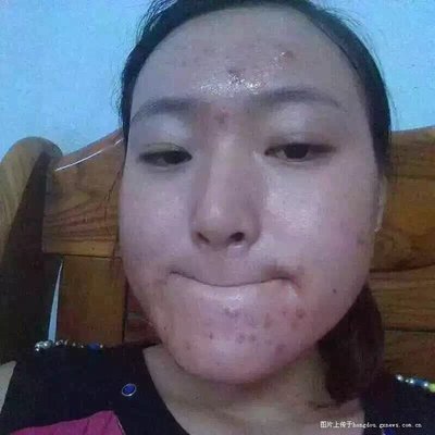 满脸痘痘可以做销售吗