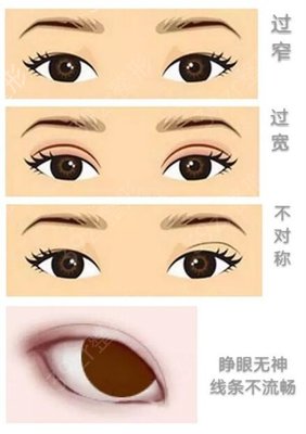 全切双眼皮拆线后注意事项