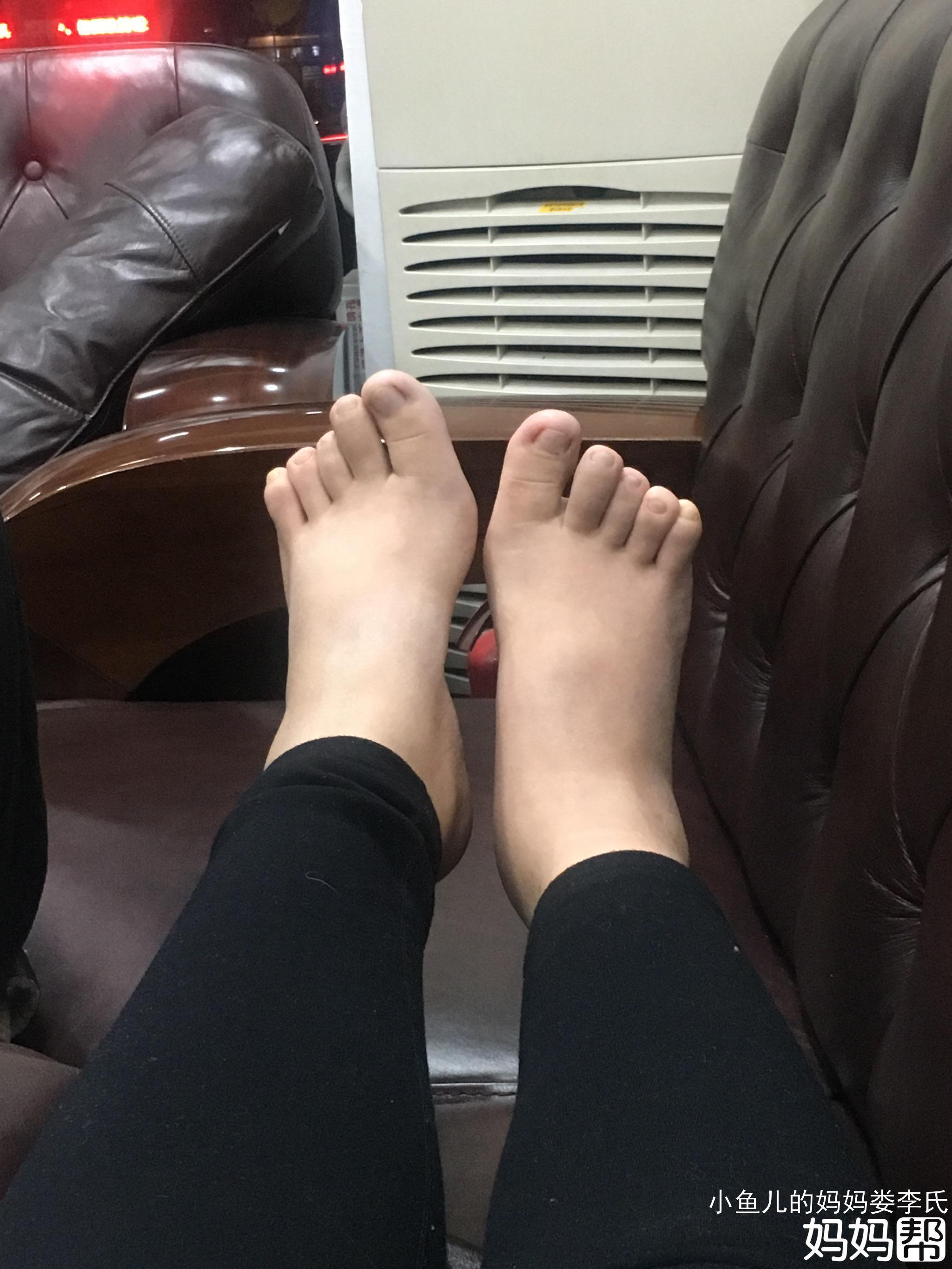 孕妇脚肿是什么原因