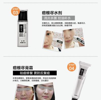 去痘痘根