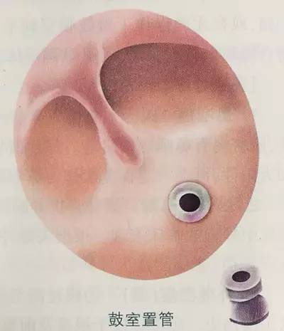 新生儿中耳积液
