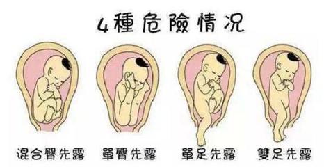 胎儿发育畸形