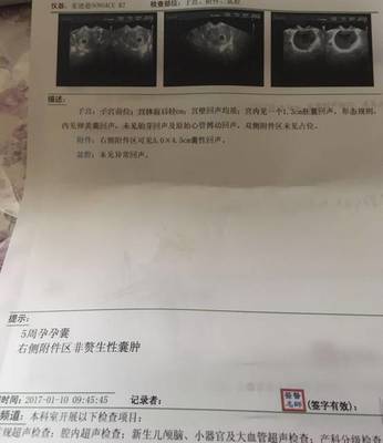排卵期囊肿