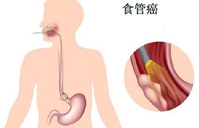 食道疼是怎么回事