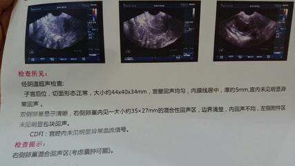 巧克力囊肿手术后多久可以怀孕