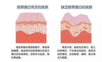 胶原蛋白会长痘痘吗