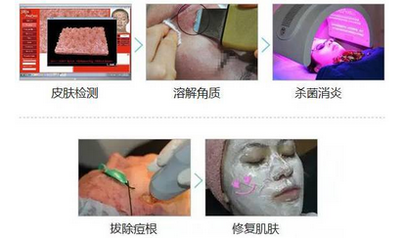 上海激光治疗痘痘