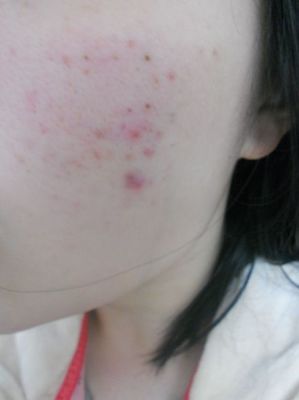 从痘痘里挤出来的是什么