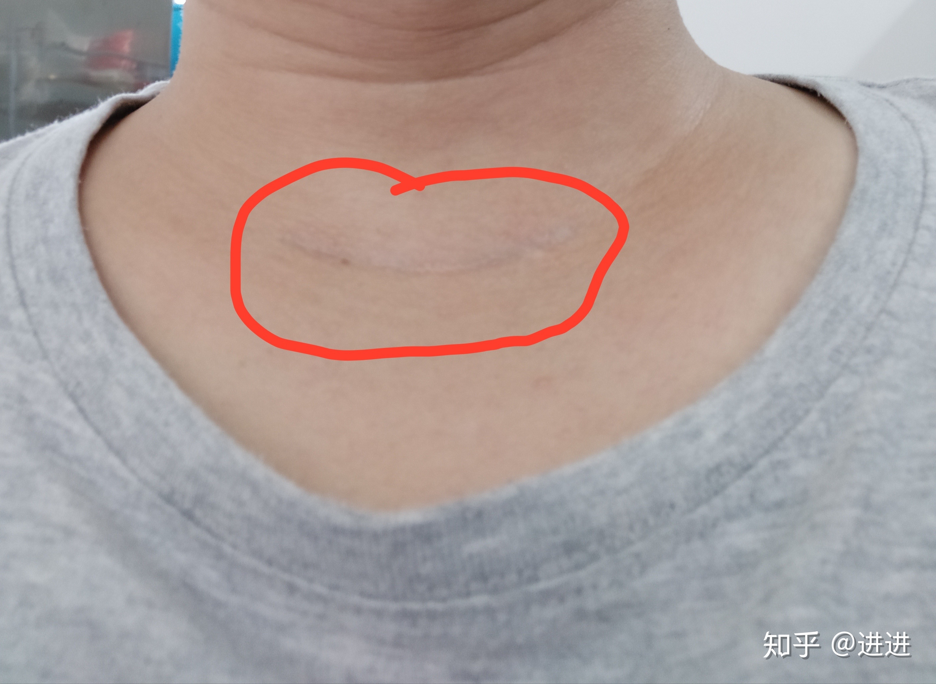 疤痕修复最佳时间