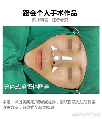 分体式隆鼻