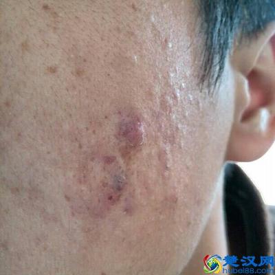 痘痘留下疤痕怎么办