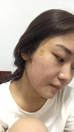 沈阳哪里打瘦脸针正规